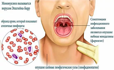 Лечение вируса Эпштейна Барра (ВЭБ) в Санкт-Петербурге. Лечение инфекции  герпеса 4 типа у взрослых и детей.