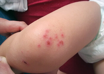 Классификация атопического дерматита у детей