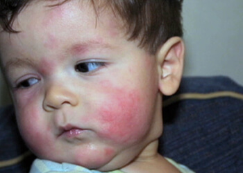 лечение аллергического дерматита у детей