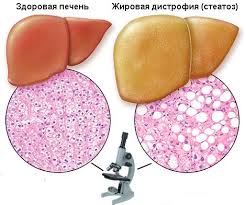 Что такое жировой гепатоз поджелудочной. Смотреть фото Что такое жировой гепатоз поджелудочной. Смотреть картинку Что такое жировой гепатоз поджелудочной. Картинка про Что такое жировой гепатоз поджелудочной. Фото Что такое жировой гепатоз поджелудочной